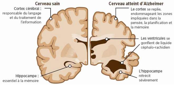 La destruction du cerveau par la maladie d'Alzheimer
